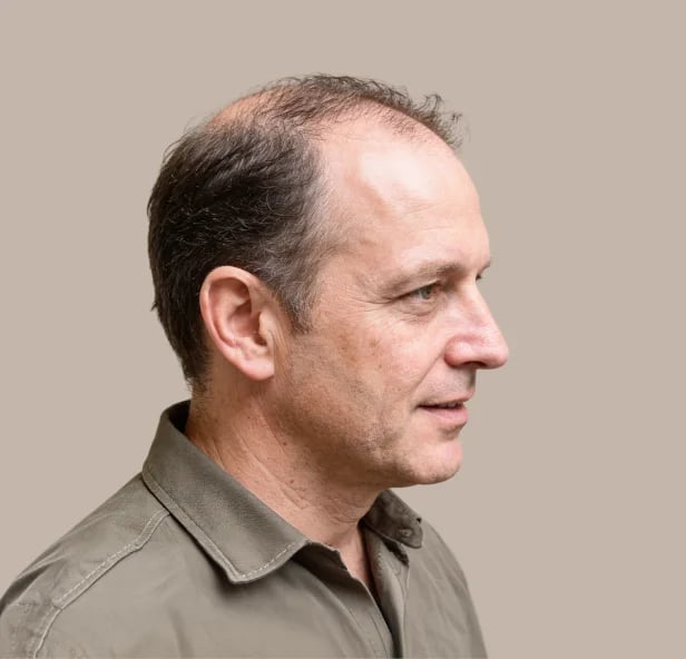 Scalp and hair density in week one